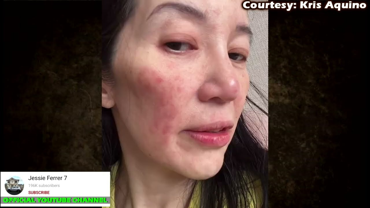 ALARMING NA RESULTA: Kris Aquino, Ibinunyag ang Panganib na Permanenteng Masira ang Puso at Baga; Ang Kanyang Laban Para sa Buhay